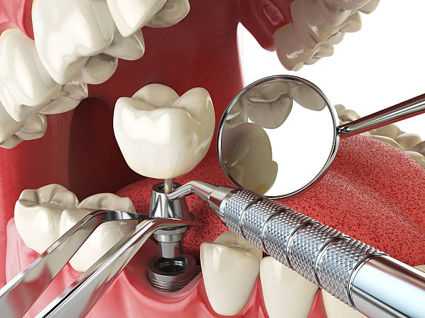 Best Dentist for Tooth Abscess  in Atlanta, IL